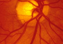 Вікова макулярна дегенерація.