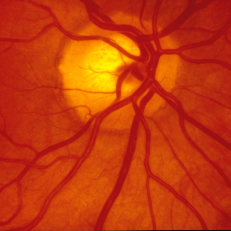 Вікова макулярна дегенерація.